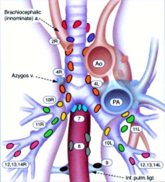 Лимфоузлы средостения легкого. Лимфоузлы средостения внутригрудные лимфоузлы. Классификация лимфоузлов средостения. Лимфатические узлы средостения схема. Схема внутригрудных лимфатических узлов.