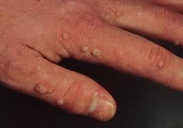 Μυρμηκιές (ακροχορδονες) Αίτιο Ιός ανθρώπινων θηλωμάτων (HPV) Επώδυνες καλοήθεις βλάβες της επιδερμίδας υπό τη μορφή βλατίδων Συνηθως στα δακτυλα των χεριών και τα πέλματα