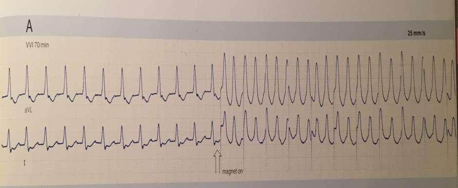 ARRHYTHMIA DURING MAGNET TEST When the magnet is applied,