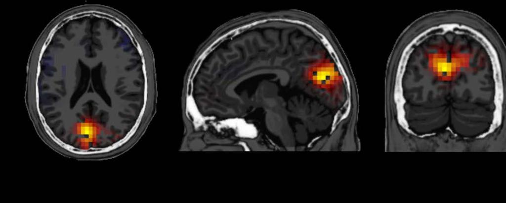 Αποθορυβοποίηση νου μετά την άσκηση Διαφορά της λειτουργίας του εγκεφάλου πριν και μετά τη συνδυασμένη άσκηση Styliadis. et al.