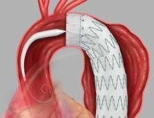 Είναι σχετικά κοντά τα delivery systems (1 m) Μεγάλου μήκους stent-graft (>10cm)