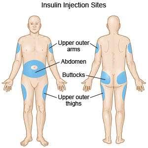 Τεχνικές χορήγησης ινσουλίνης στους αθλητές Επιλογή ενός προκαθορισμένου σημείου χορήγησης