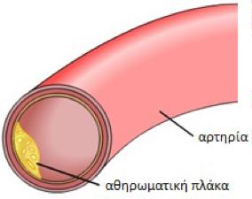 (αʹ) Σχήμα 1.2: Σχηματική αναπαράσταση (α ) αρτηρίας με αθηρωμάτωση και (β ) της ενδεχόμενης εξέλιξης της νόσου. (βʹ) αλλοιώσεων [2].