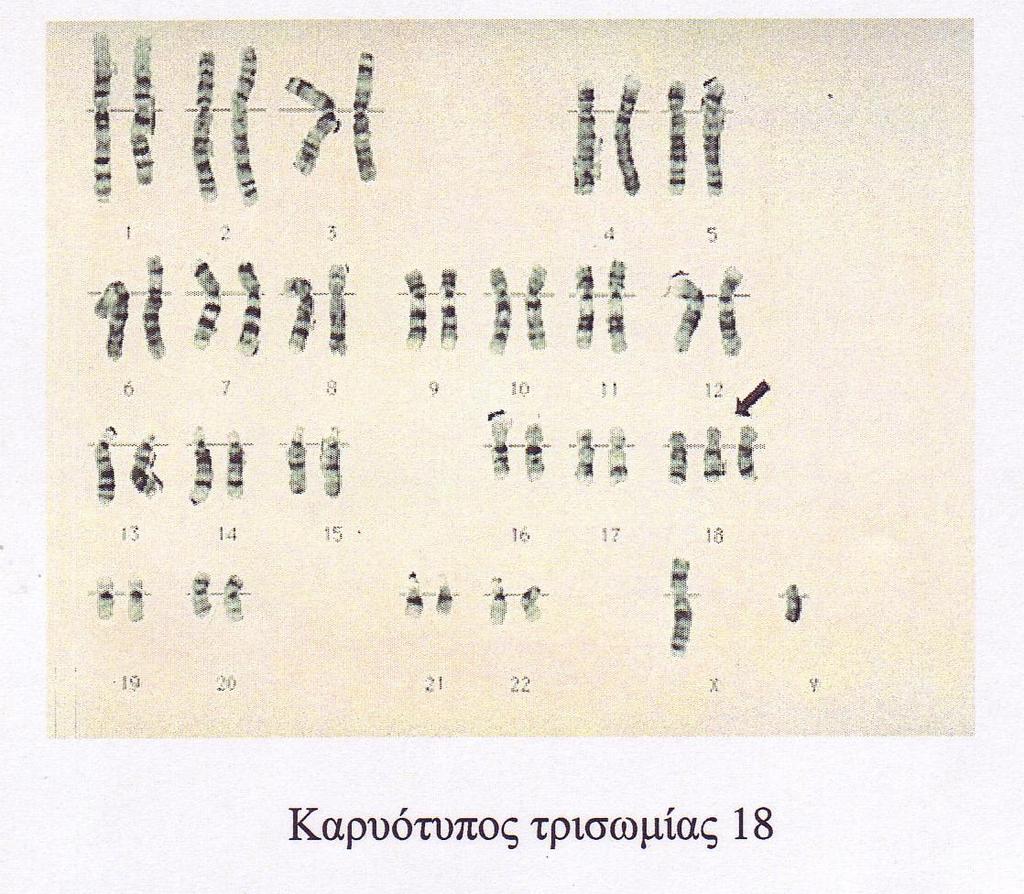 Τρισωμία 18 (σ.