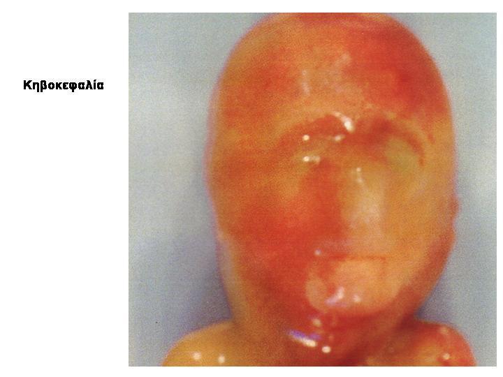 Κυκλωπία Τρισωμία 13 Κηβοκεφαλία Cebocephaly (κήβος = πίθηκος) Σύμφυση των 2 οφθαλμών στη