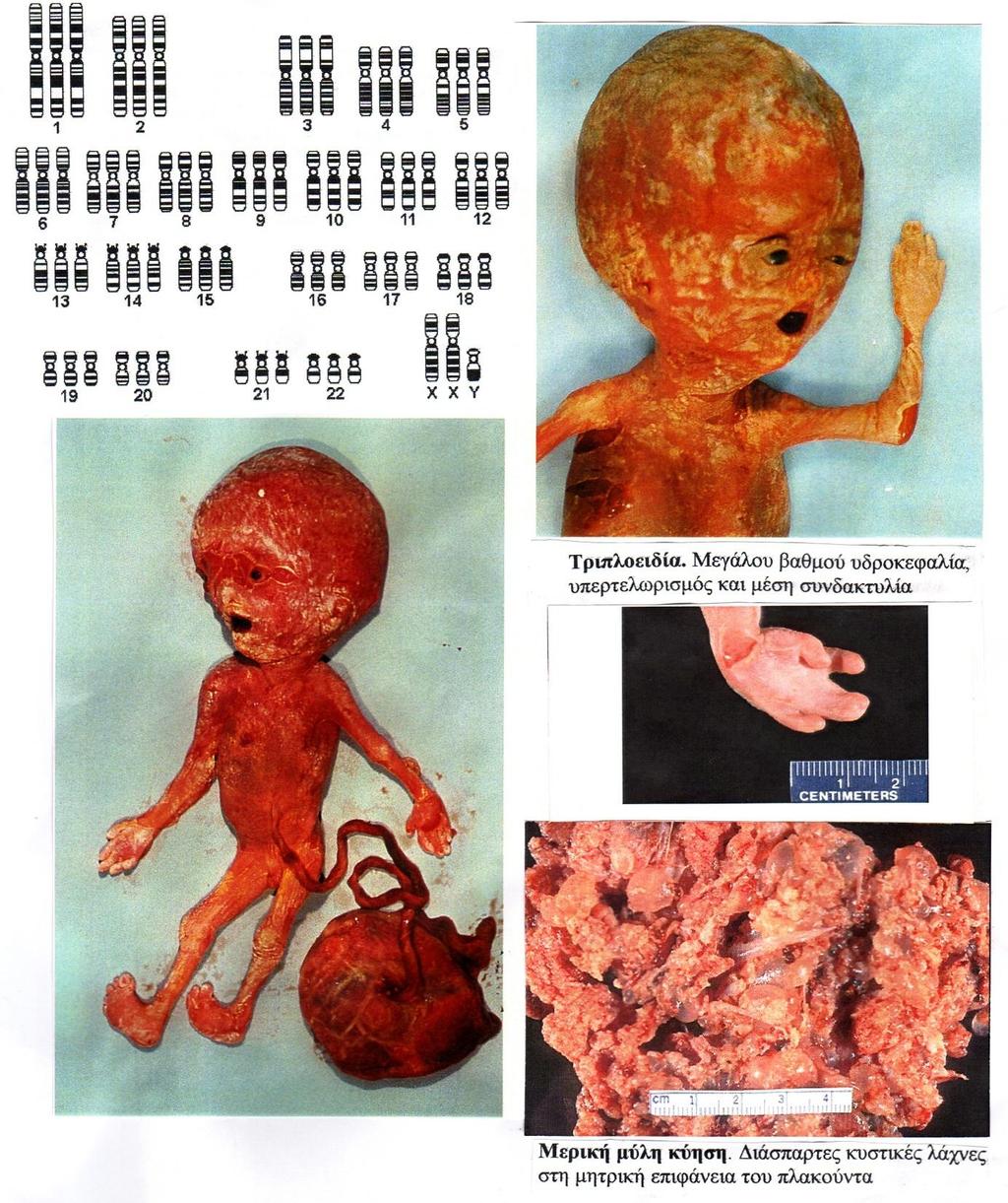 Τριπλοειδία 69,