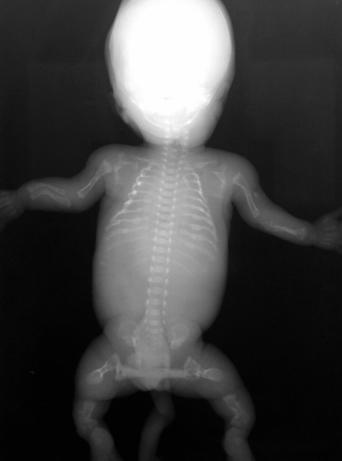 19 wk μετάλλαξη