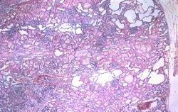 ΑDPKD