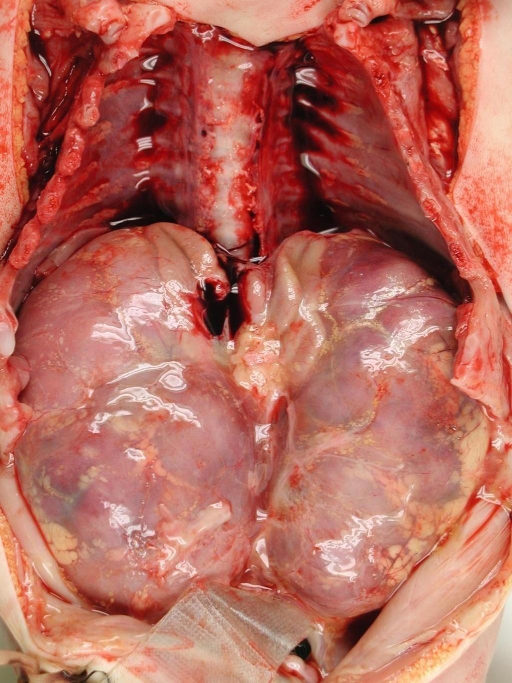 ARPKD αμφότεροι οι νεφροί