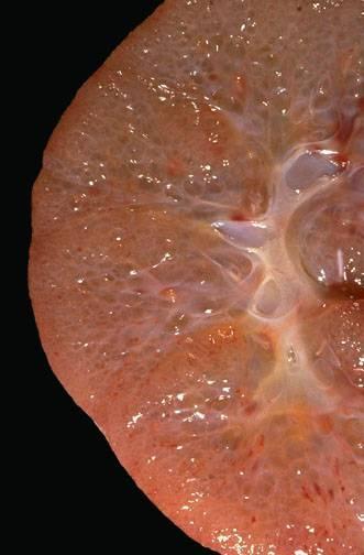 ARPKD