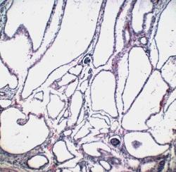 ARPKD Ιστολογία Κυστική