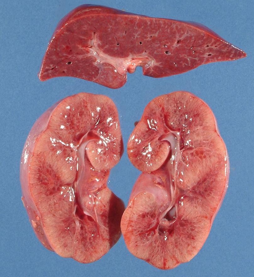 ARPKD