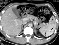 Τομογραφία Εκπομπής Ποζιτρονίων - PET Scan (Positron Emission Tomography) Η τομογραφία εκπομπής ποζιτρονίων (PET), εφαρμόζεται ως μέθοδος μελέτης των ασθενών με HL την τελευταία δεκαετία.