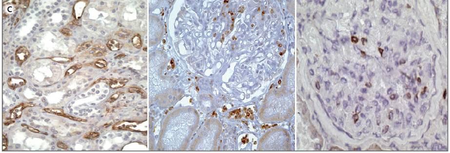 Συνοπτικά C4d CD68 NKp46 Ενεργός αντισωματικού τύπου απόρριψη με γραμμική εναπόθεση C4d στα τριχοειδή (ΑΡ) και σπειραματική και τριχοειδική διήθηση από μονοκύτταρα ή μακροφάγα