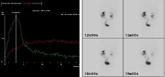 Διουρητικό νεφρόγραμμα (MAG-3) Καθυστερημένη αποχέτευση του ραδιοφαρμάκου (κόκκινη