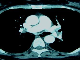 Spiral / Multislice CT Results