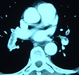 Artery Thrombus Rt Pulmonary