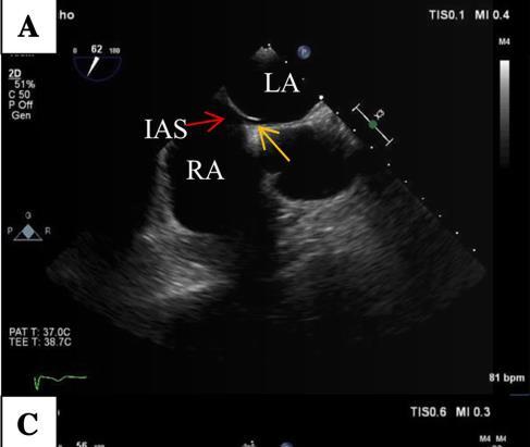 ovale (PFO) είναι