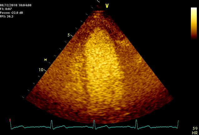 Myocardial