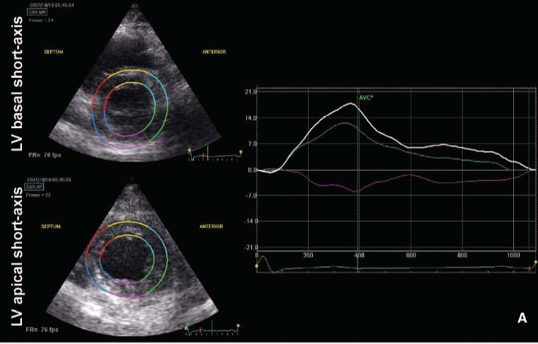 Reduced Left Ventricular Torsion Early After Myocardial Infarction