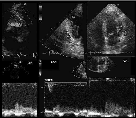 Non-invasive coronary flow reserve after successful primary angioplasty for acute anterior myocardial infarction is an