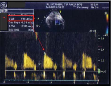 The accuracy of deceleration time of diastolic coronary flow measured by transthoracic echocardiography in predicting long-term left