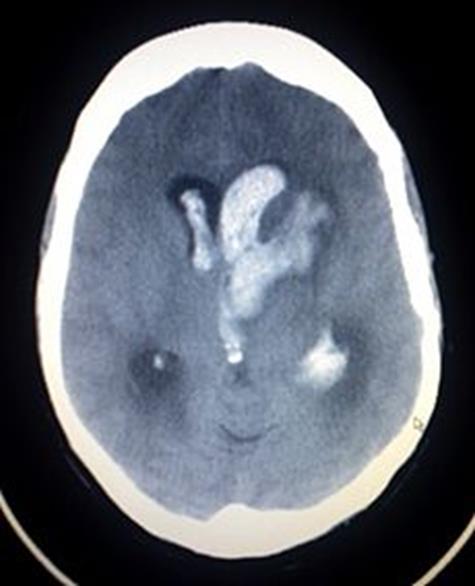 Screening CT