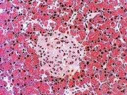 ανεπάρκεια του β-κυττάρου