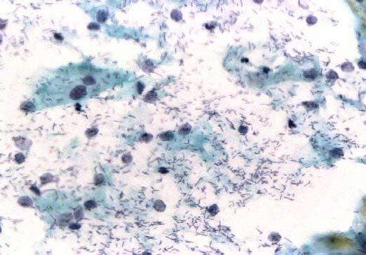 IIΙβ. Βακτηριακή παρεμβολή Streptococcus viridans: προλαμβάνει