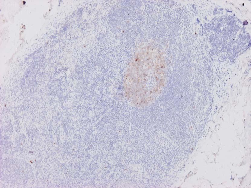 CD10 BCL2 CD23 Δεν