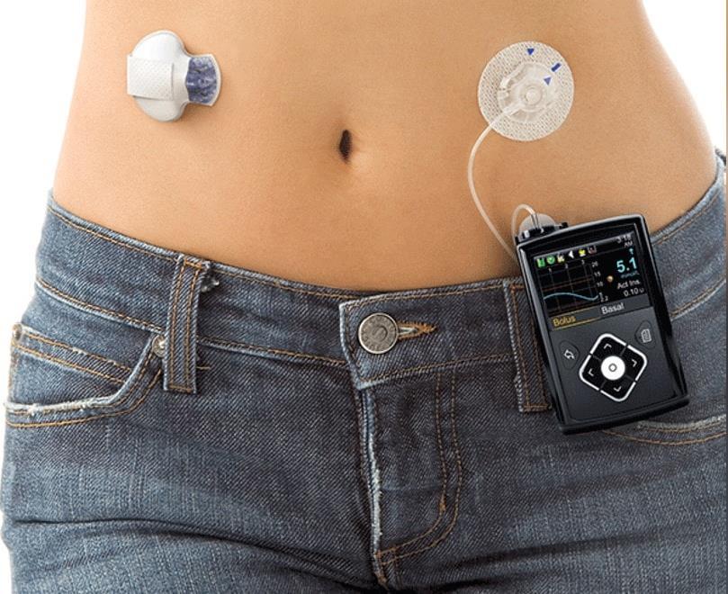 (CGMS): Minimed 640G Insulin