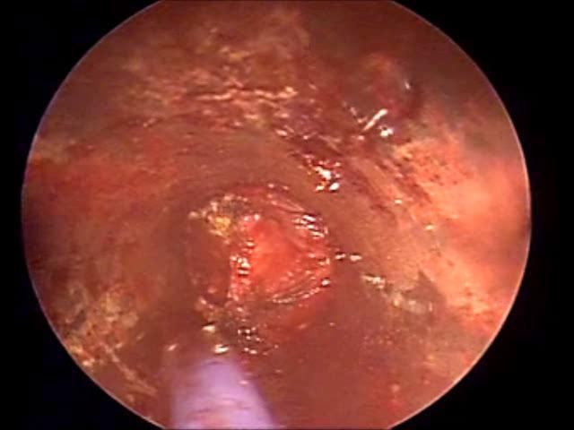 Ηλεκτροκαυτηρία επαφής (probe, forceps,