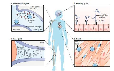 Παθογενετικοί μηχανισμοί a) Generalized immune activation b) Direct off-target effects of checkpoint inhibitors c) Pre-existing asymptomatic