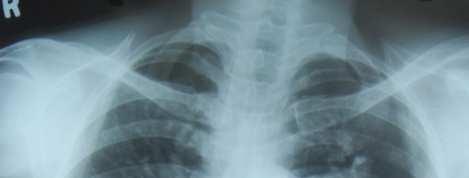 Πνευµονική Υπέρταση- Chest X-ray Ακτινογραφία