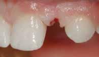 Σε μία μελέτη βρέθηκε πως για ένα κανονικό εμφύτευμα δύο τεμαχίων, θα πρέπει να τοποθετηθεί σε απόσταση τουλάχιστον 1.5 χιλιοστού από τα παρακείμενα δόντια.