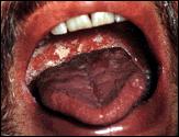 Kaposi s sarcoma Μυκητίαση στο στόμα AIDS Προκαλείται από τον ιό ΗΙV και μπορεί να καταστρέψει το ανοσοποιητικό σύστημα με