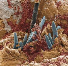 Demodex Η βλεφαρίτιδα σταδιακά οδηγεί σε νόσο ξηρού οφθαλμού και η ενοποιημένη θεωρία Ξηροφθαλμίας-Βλεφαρίτιδας 5 (DEBS: Dry Eye Blepharitis Syndrome) αποκτά όλο και ισχυρότερη τεκμηρίωση.