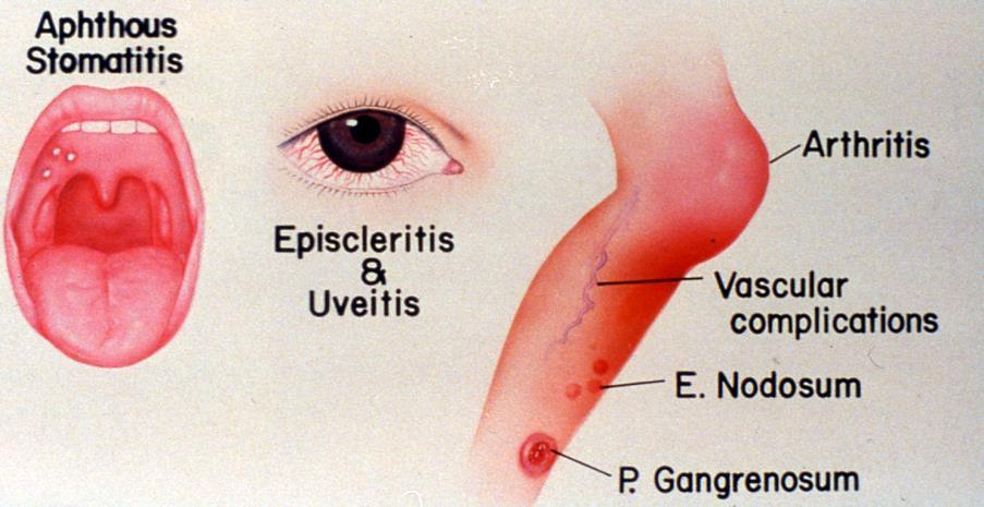 Εξωεντερικές εκδηλώσεις της νόσου Κυρίως από το δέρμα, το στόμα, τους οφθαλμούς και τις αρθρώσεις (25% των ασθενών) Παράλληλη πορεία με τη νόσο.