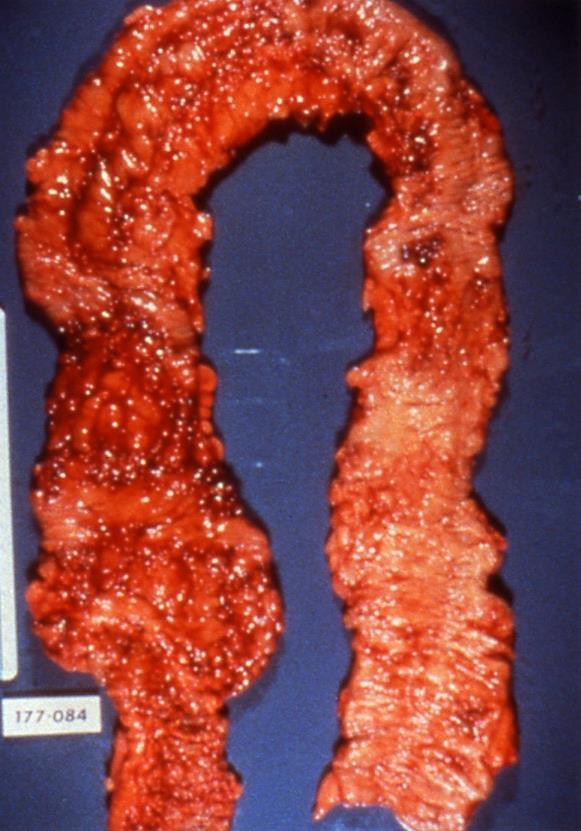 ΝΟΣΟΣ CROHN