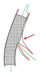 Διαδικασία της στρατηγικής 1 stent Βελτιστοποιήση του εγγύς τμήματος του κύριου κλάδου.