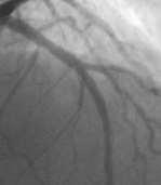 smaller angles and double BVS stenting to