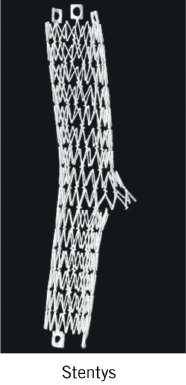 1. MB stenting