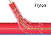 stenting