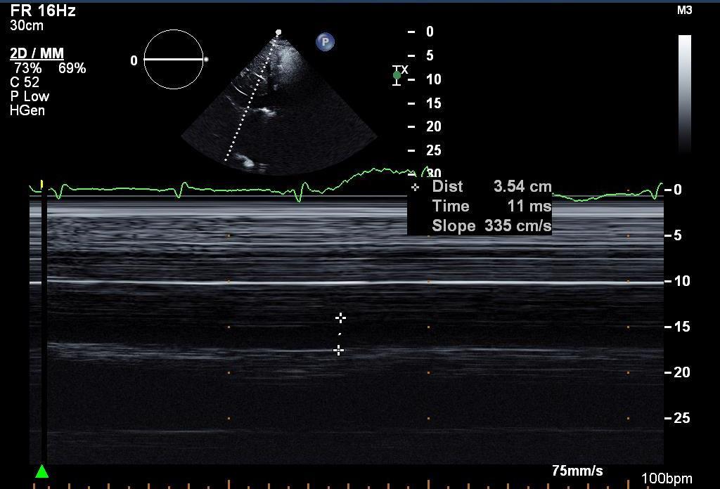 DILATED IVC (35,4 mm) WITH