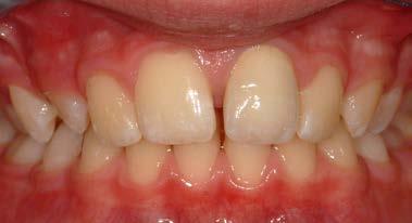 Εικόνα 8a* Ως πρότυπο για το σπασμένο δόντι 21 χρησιμοποιείται το δόντι 11 με τα ιδιαίτερα