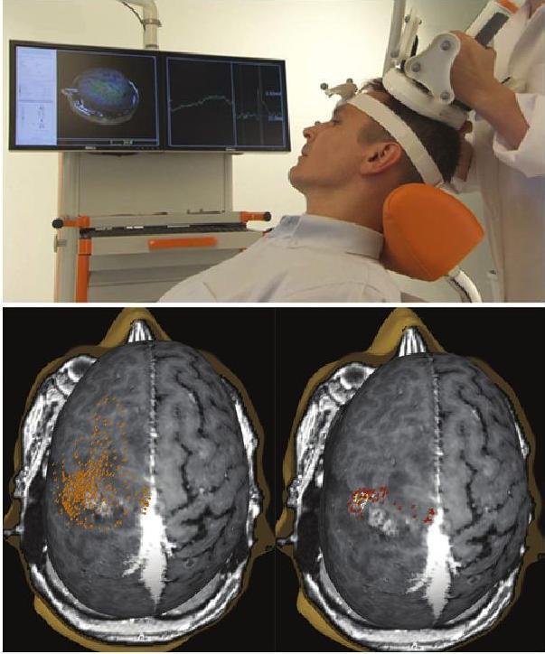 Figure 1. Upper: The "E-field navigation" TMS system in use. Reflective spheres are attached to the patient's head (modified elastic headband) and to the TMS coil.