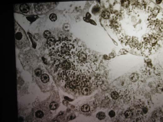 Θολερή εξοίδηση ή κυτταρική εξοίδηση κυτταρόπλασμα διογκωμένο θολερό κυτταρικά όρια ασαφή συμπίεση