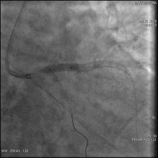 Παρουσίαση περιστατικού Γ Postdilatation