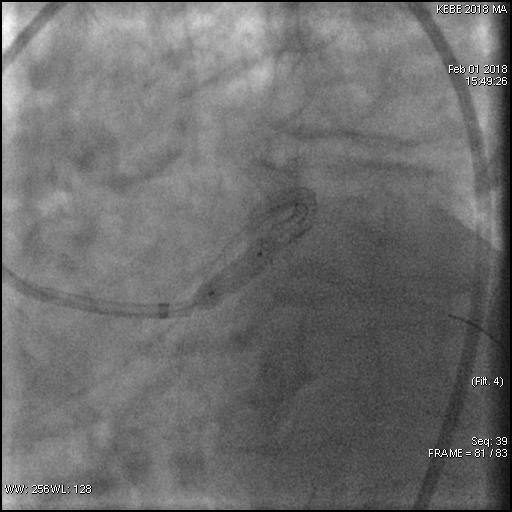 Παρουσίαση περιστατικού Γ Postdilatation