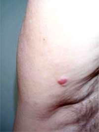 H.pylori, αυτοάνοση θυρεοειδίτις) (11;18)(q21;q21) API2-MALT1 Συνήθως εντοπισμένη νόσος